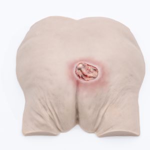 Pressure Injury Buttock Overlay - Stage 4