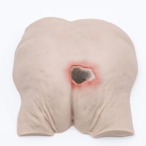 Pressure Injury Buttock Overlay - Unstageable