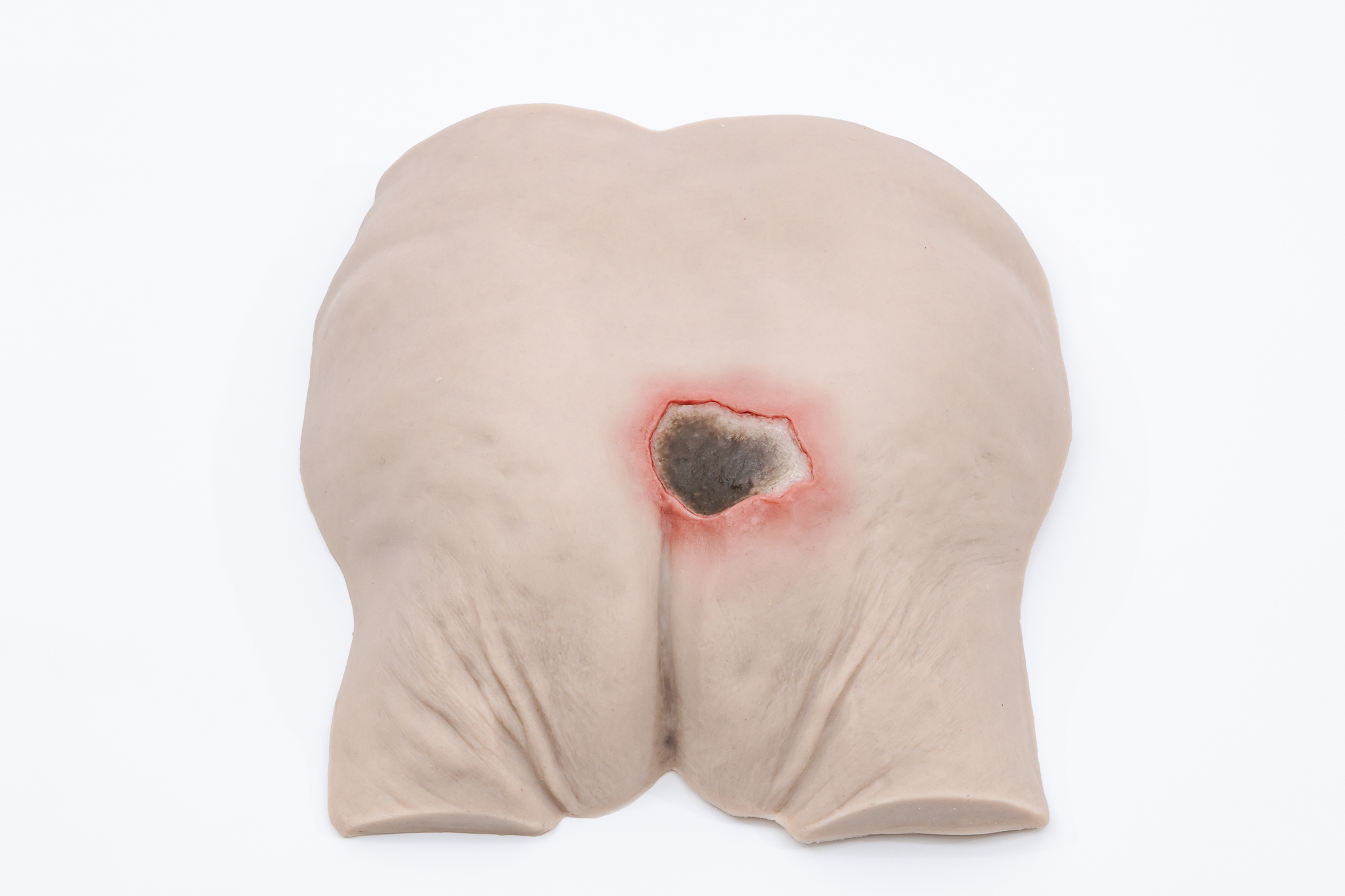 Pressure Injury Buttock Overlay - Unstageable