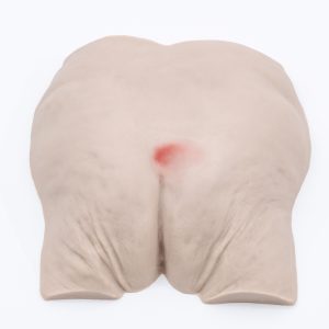 Pressure Injury Buttock Overlay - Stage 1