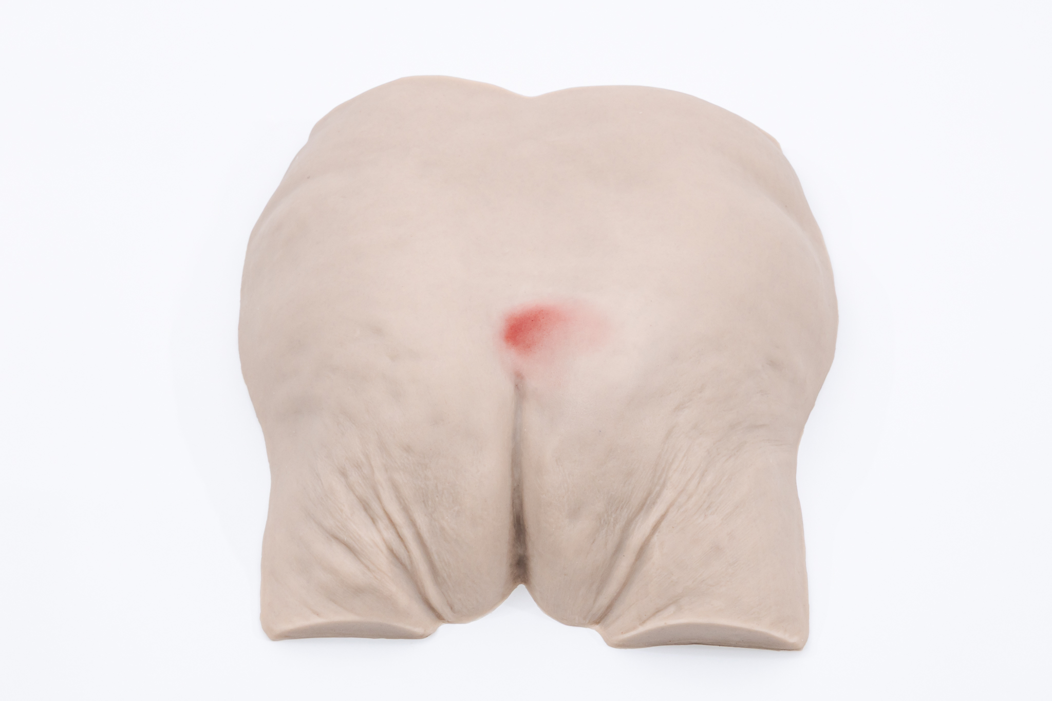 Pressure Injury Buttock Overlay - Stage 1