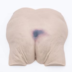 Pressure Injury Buttock Overlay - Suspected Deep Tissue Injury