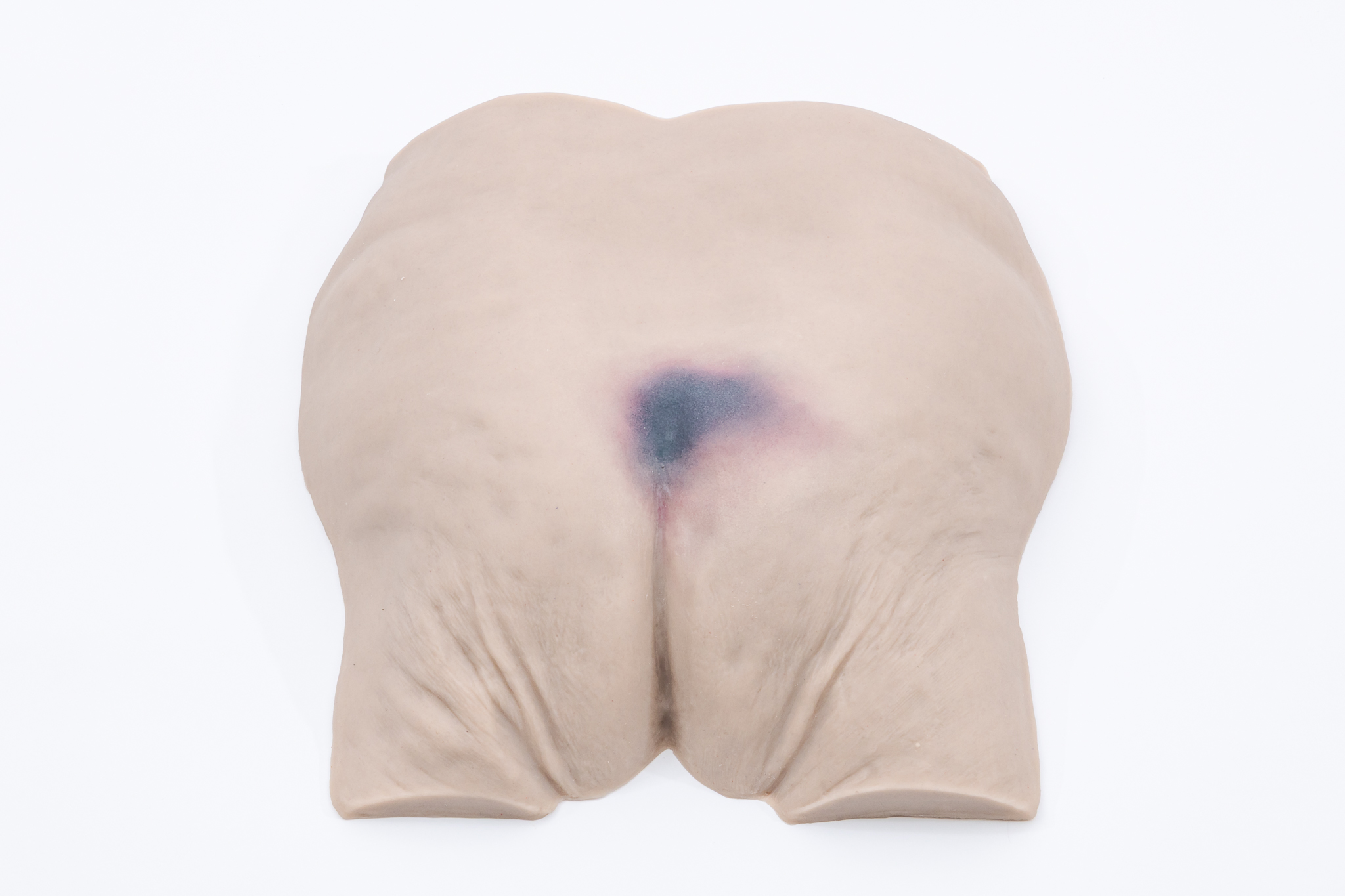 Pressure Injury Buttock Overlay - Suspected Deep Tissue Injury