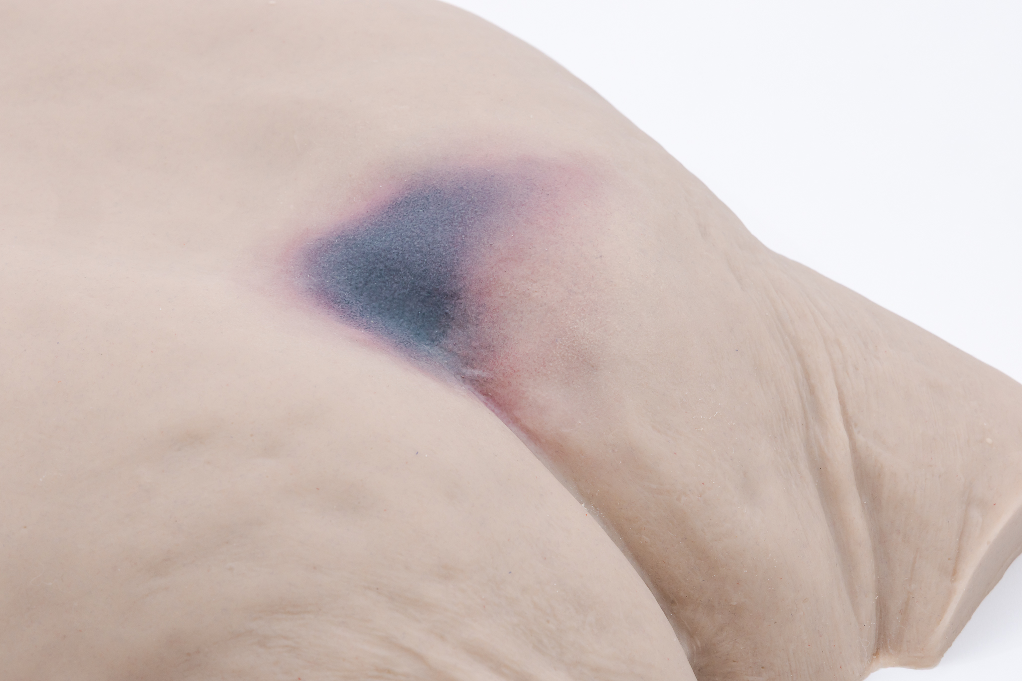 Pressure Injury Buttock Overlay - Suspected Deep Tissue Injury - Image 2