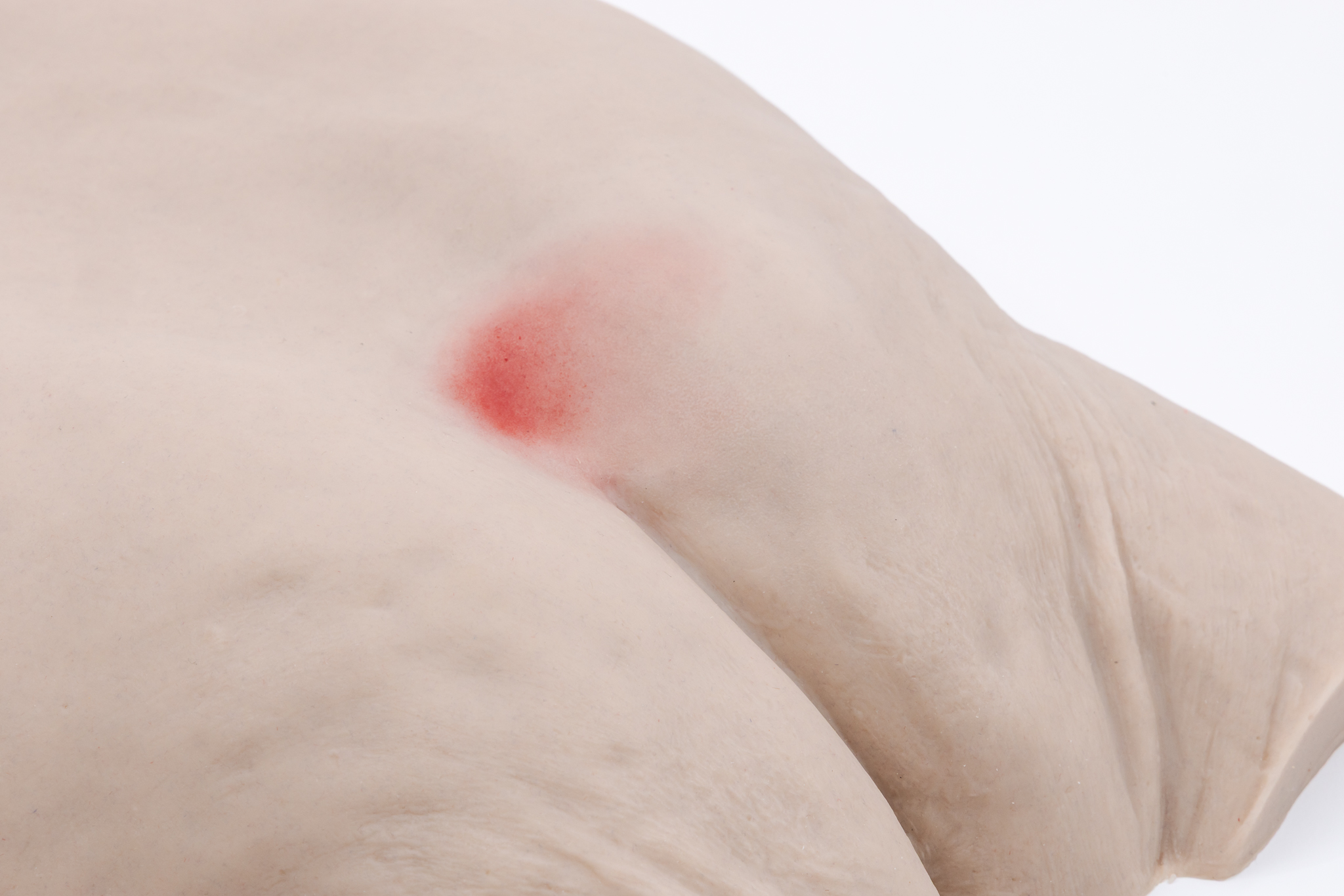 Pressure Injury Buttock Overlay - Stage 1 - Image 2