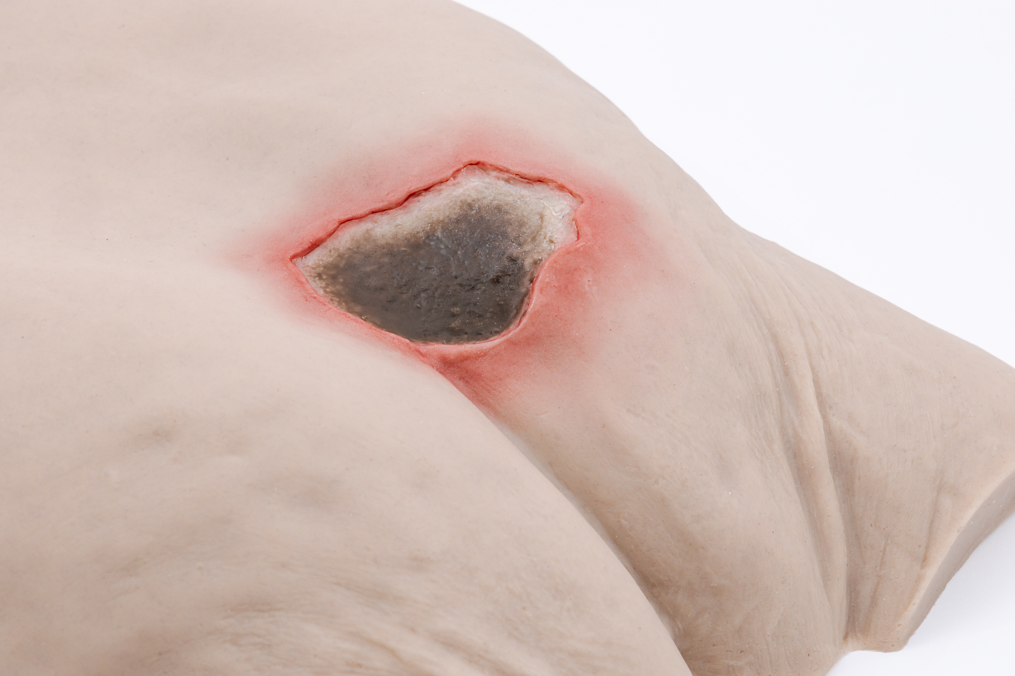 Pressure Injury Buttock Overlay - Unstageable - Image 2