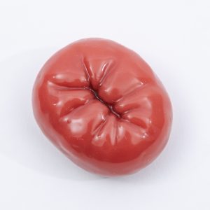 Stoma