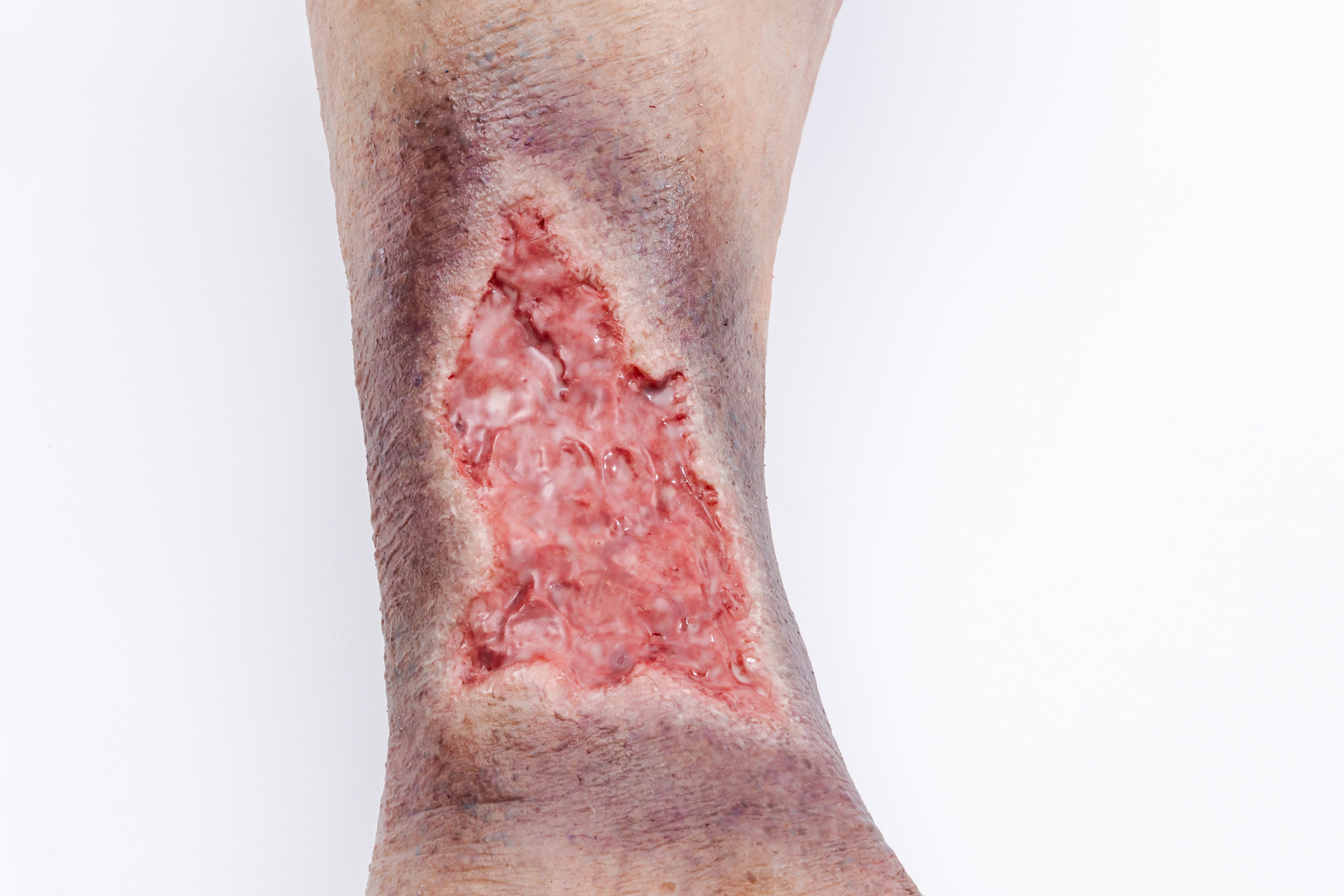 Lifecast Elderly Leg with Chronic Wounds - Image 6