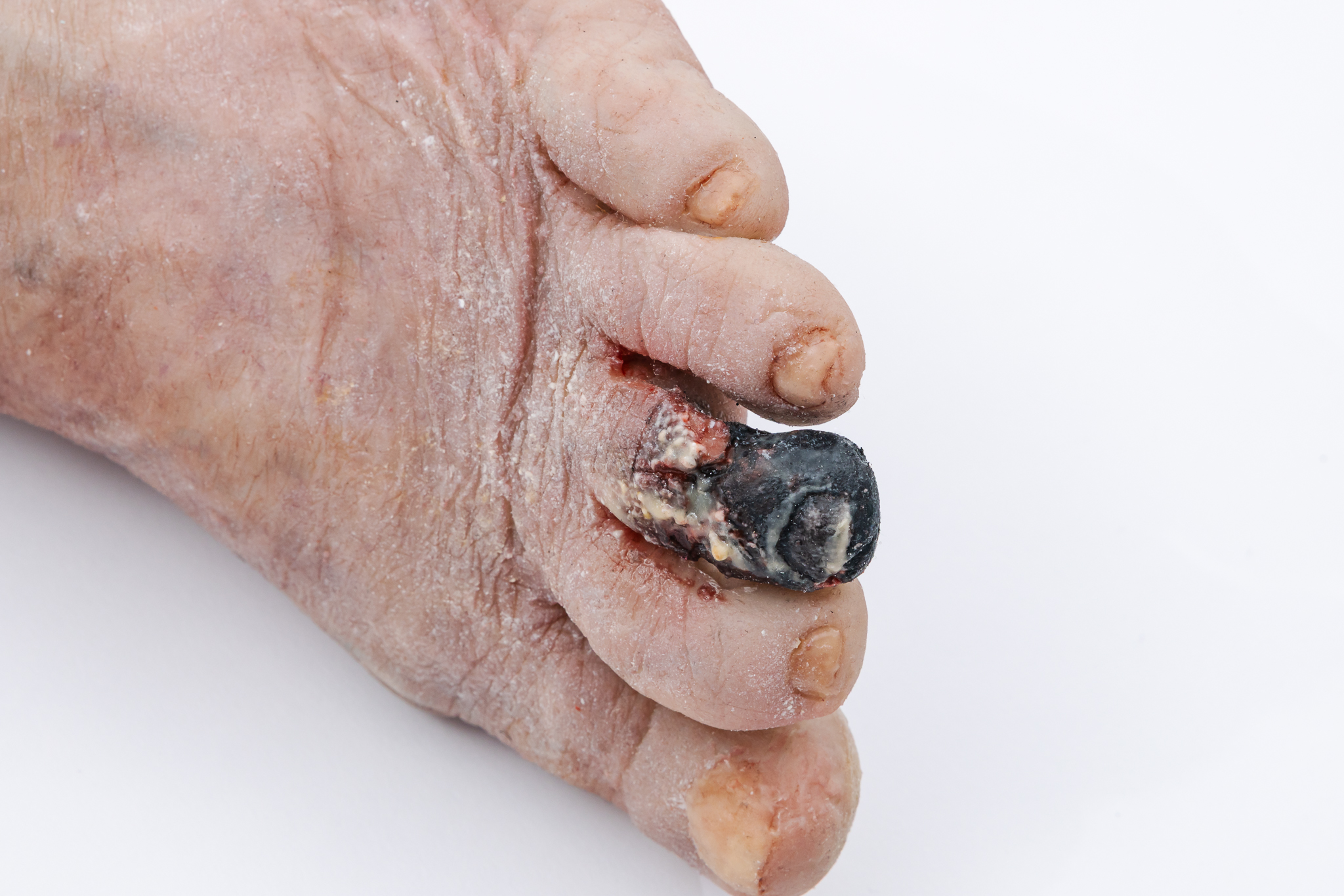 Lifecast Elderly Leg with Chronic Wounds - Image 8