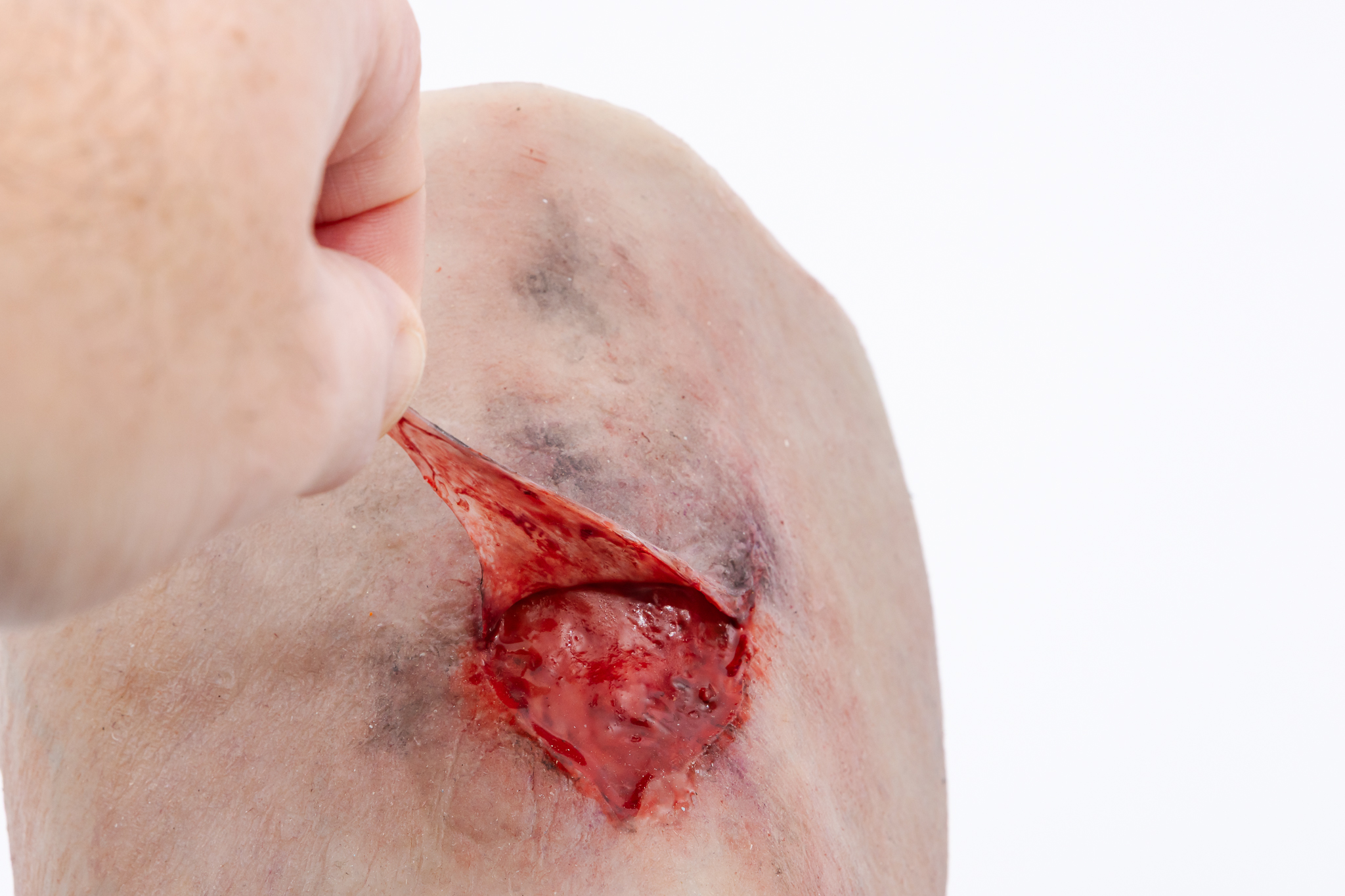 Lifecast Elderly Leg with Chronic Wounds - Image 13