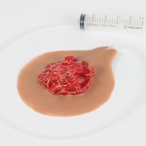 Gunshot Exit Wound Large with Bleeding Capacity