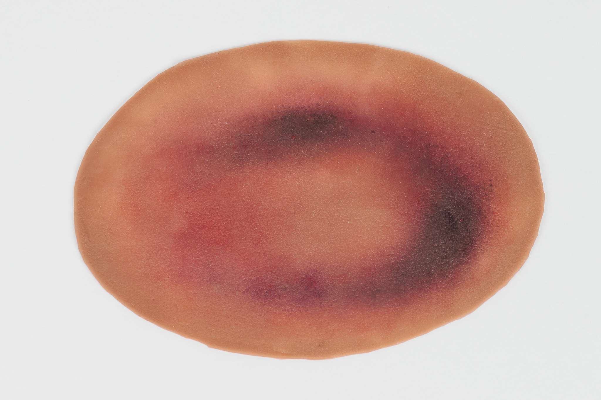 Small Haematoma - Image 5