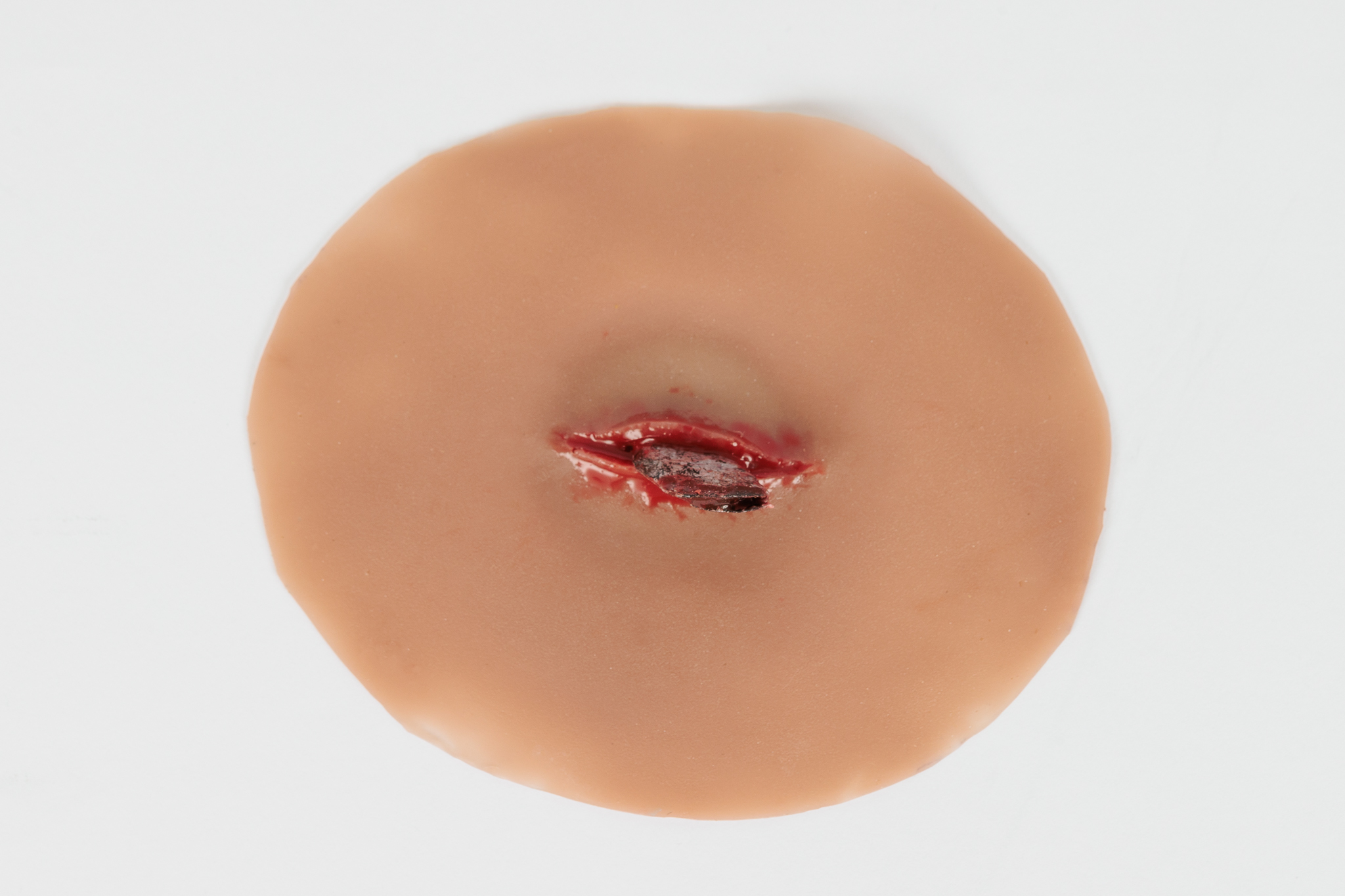 Wound with Metal Fragment - Image 5