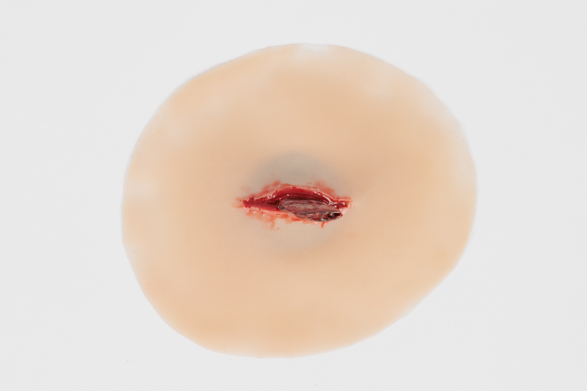 Wound with Metal Fragment - Image 6