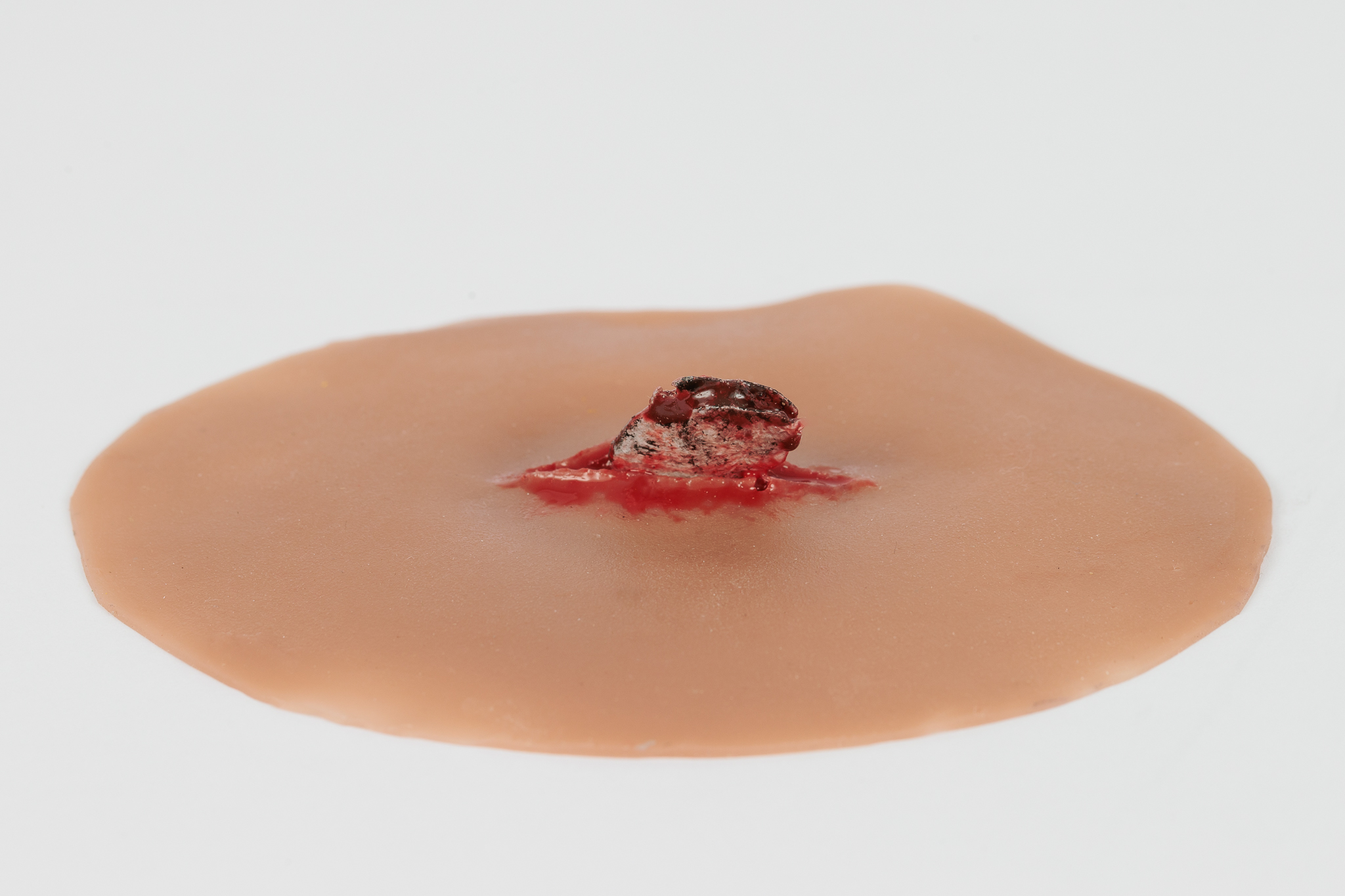 Wound with Metal Fragment - Image 3