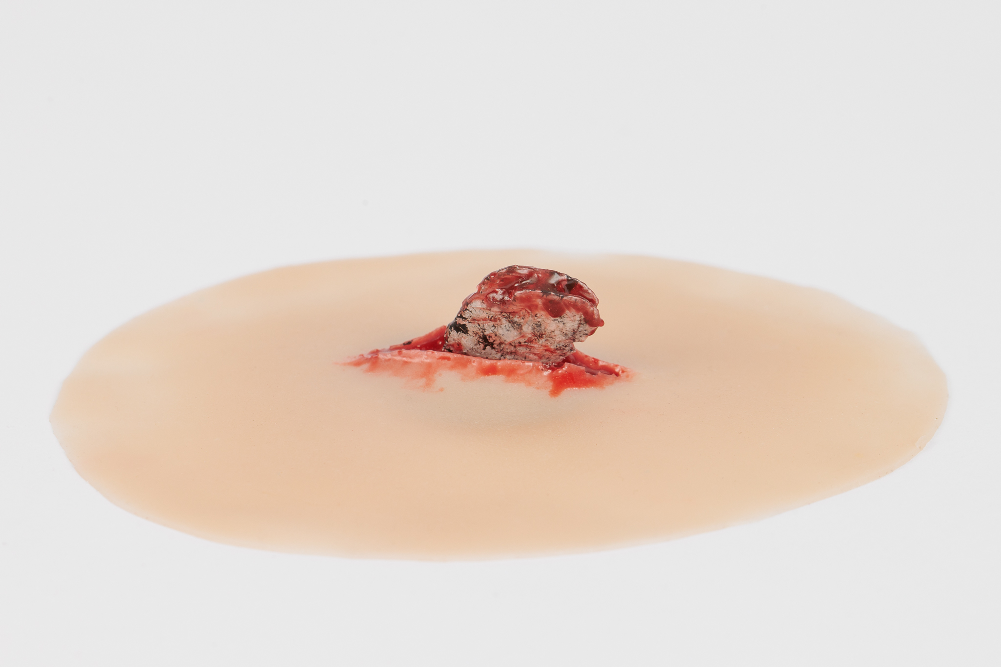 Wound with Metal Fragment - Image 4