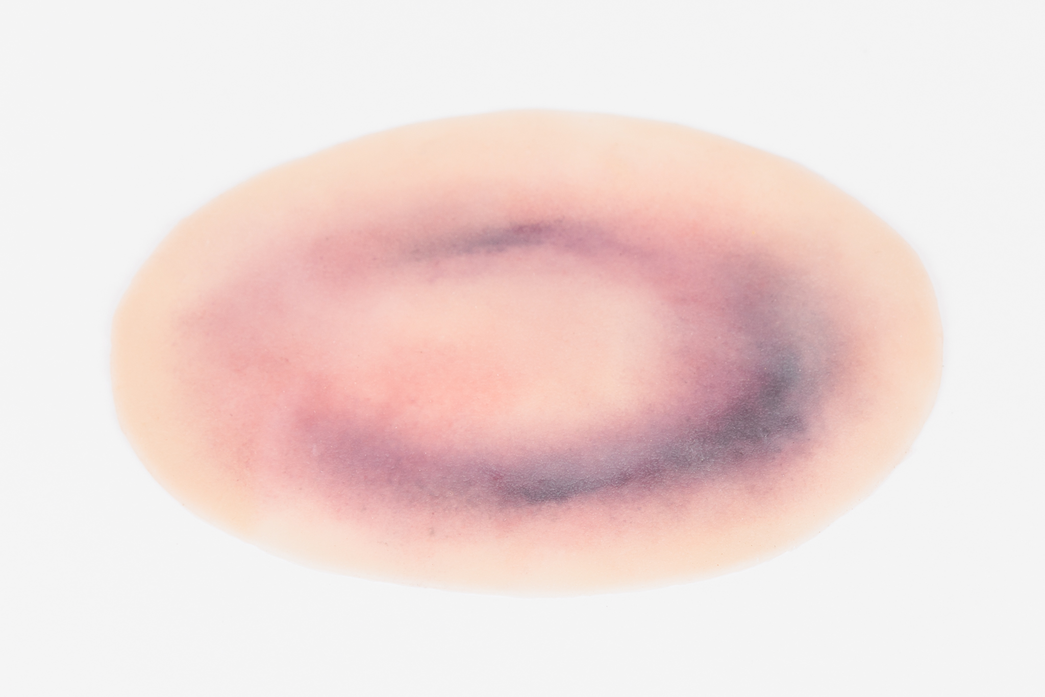Small Haematoma - Image 4