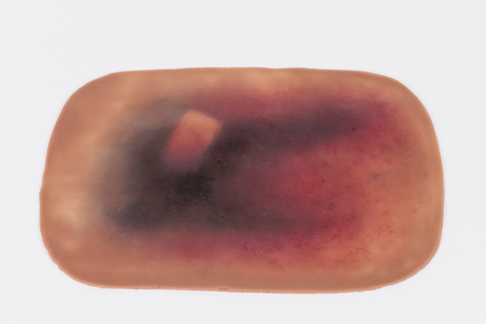 Large Haematoma - Image 5