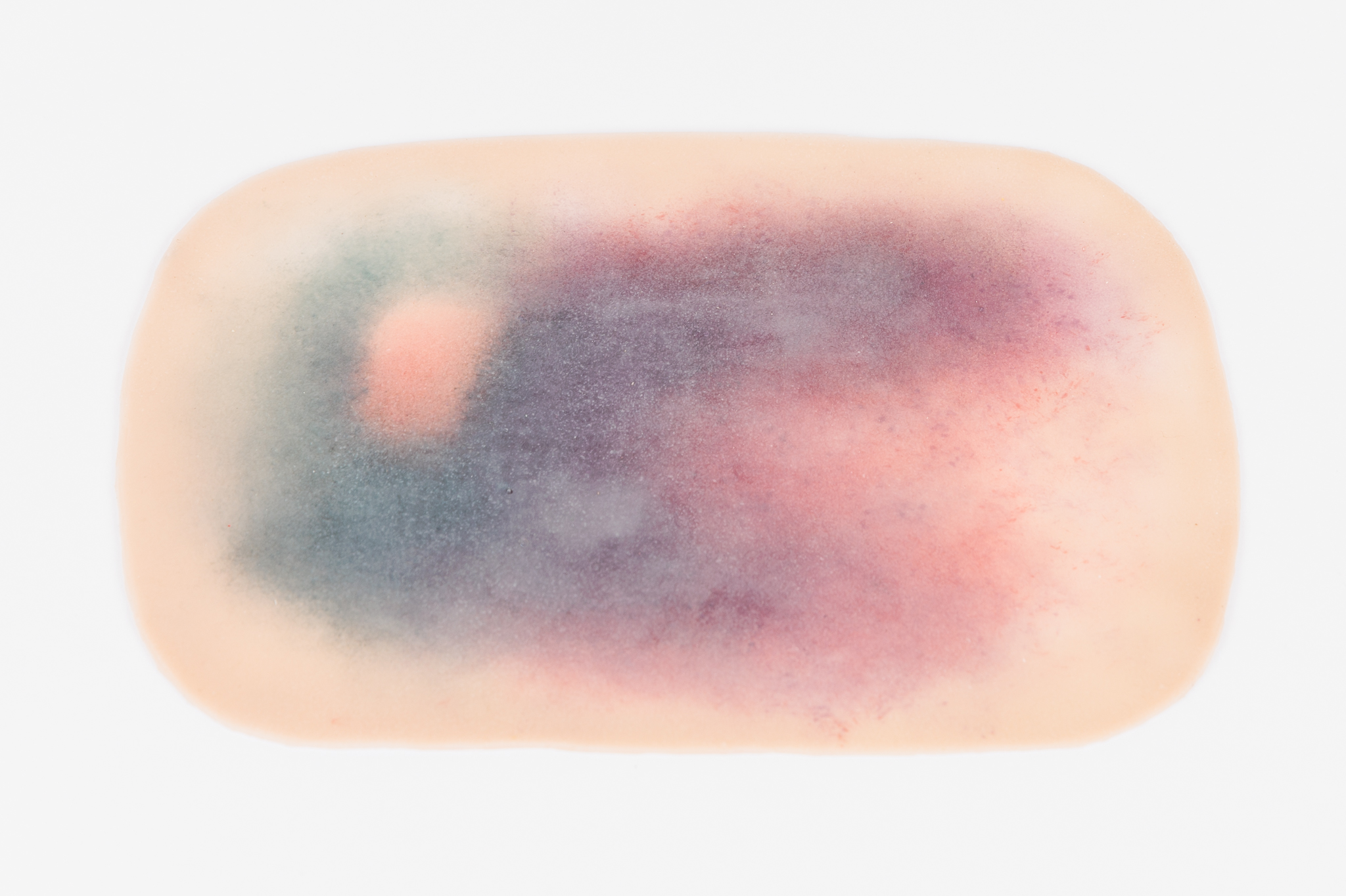 Large Haematoma - Image 4
