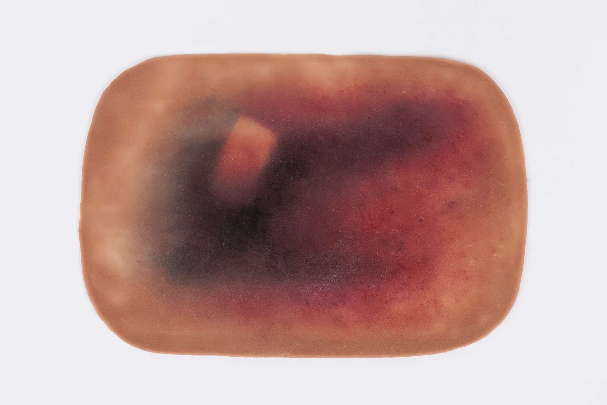 Large Haematoma - Image 6