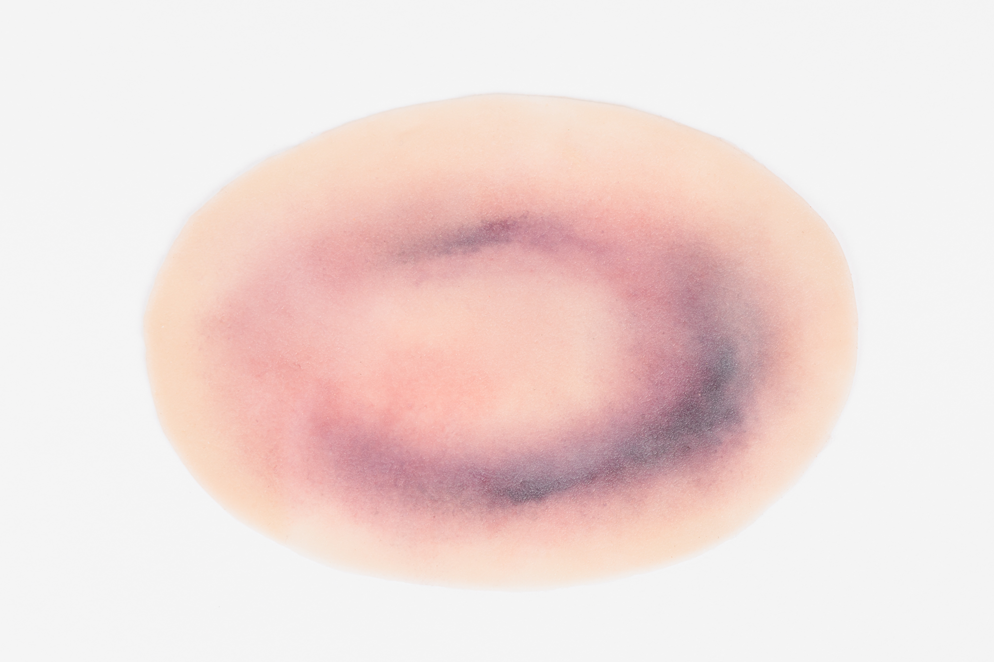 Small Haematoma - Image 6
