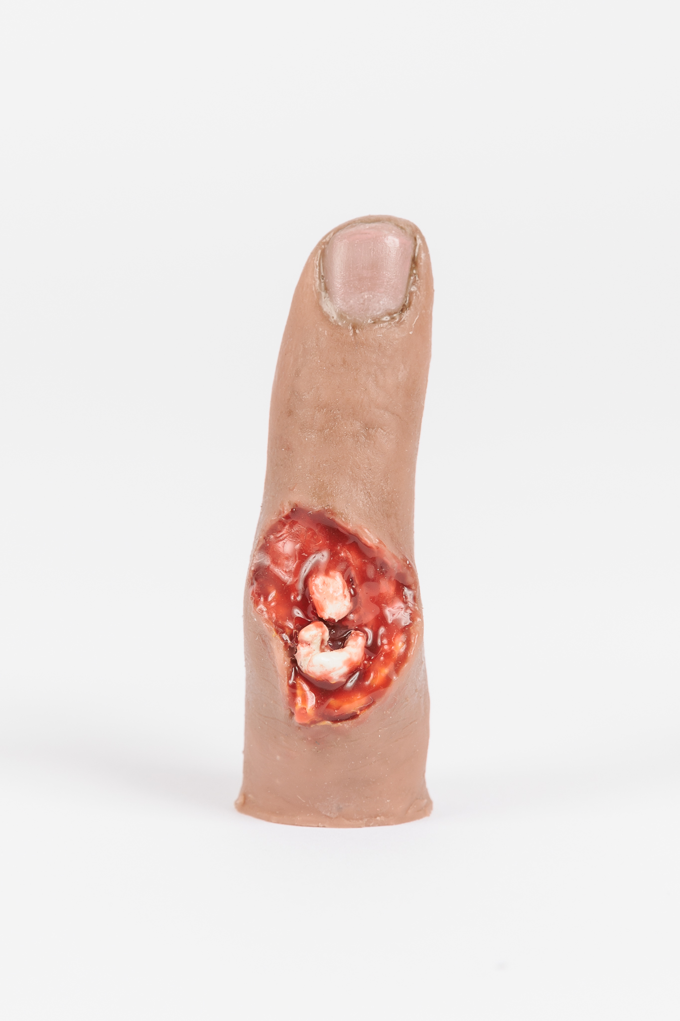 Finger Glove - Exposed Bone Injury - Image 3