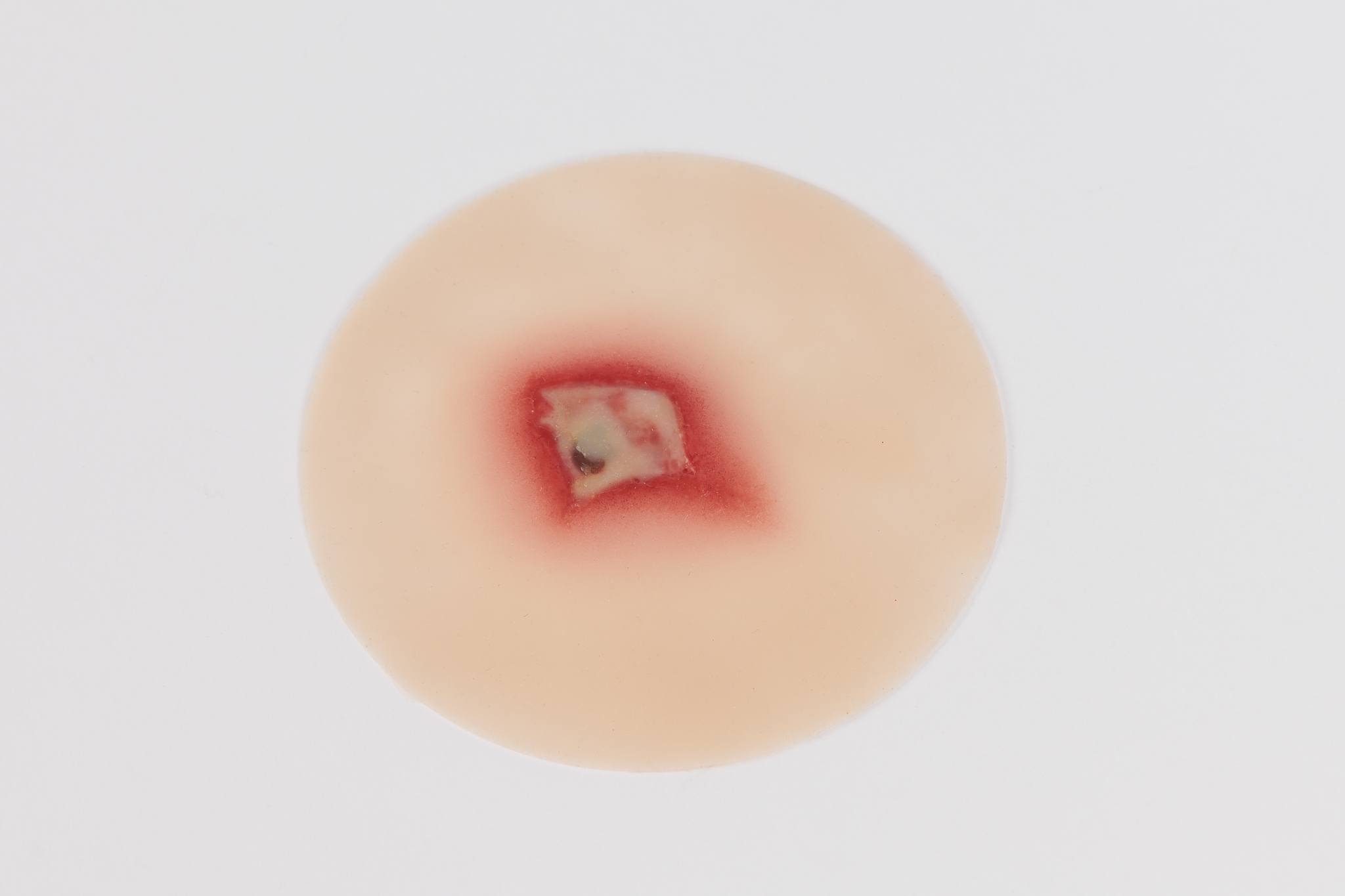Infected Insect Bite
