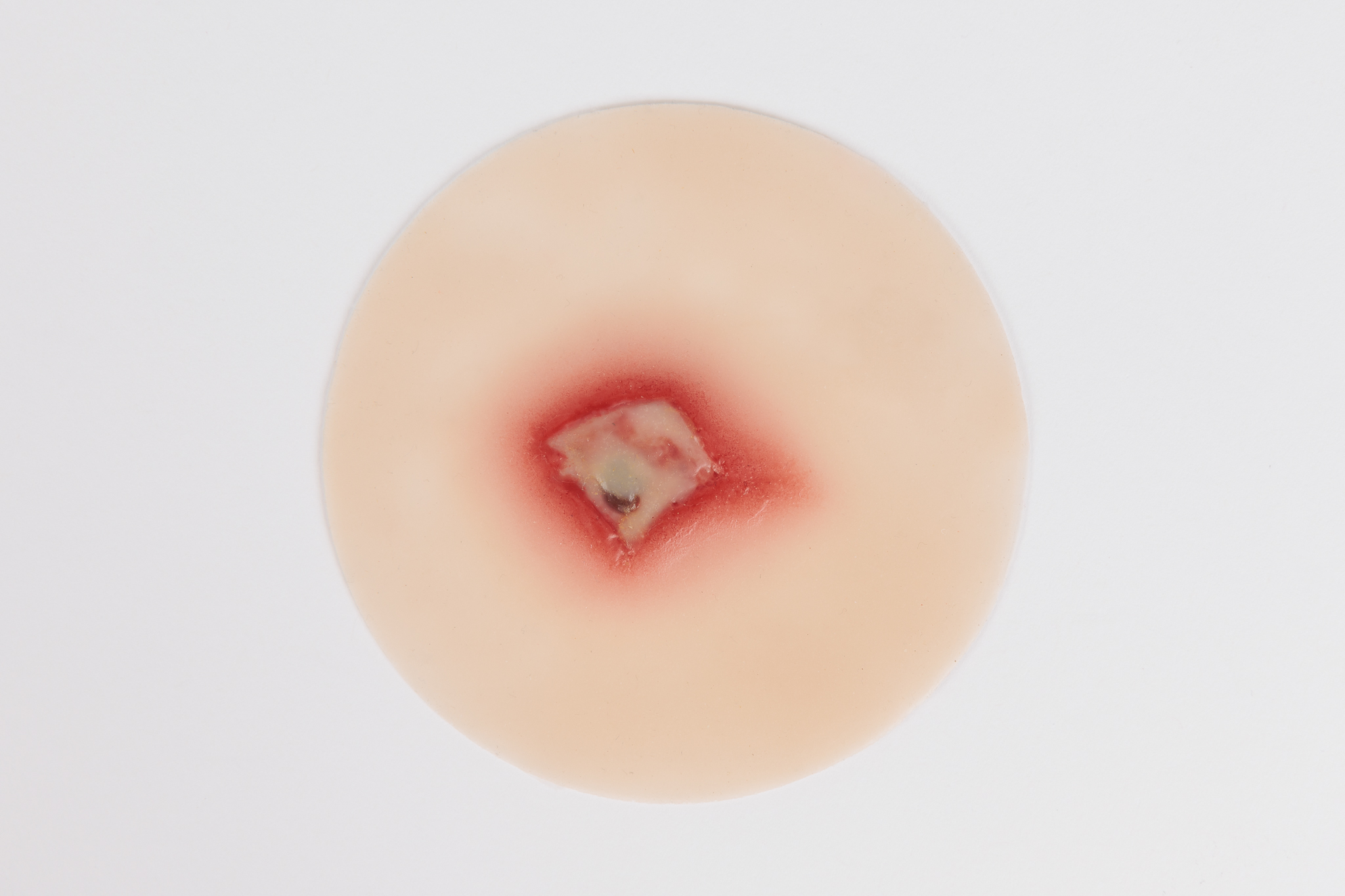 Infected Insect Bite - Image 2