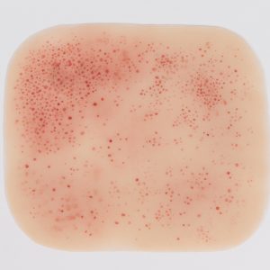 Rash - Meningococcal
