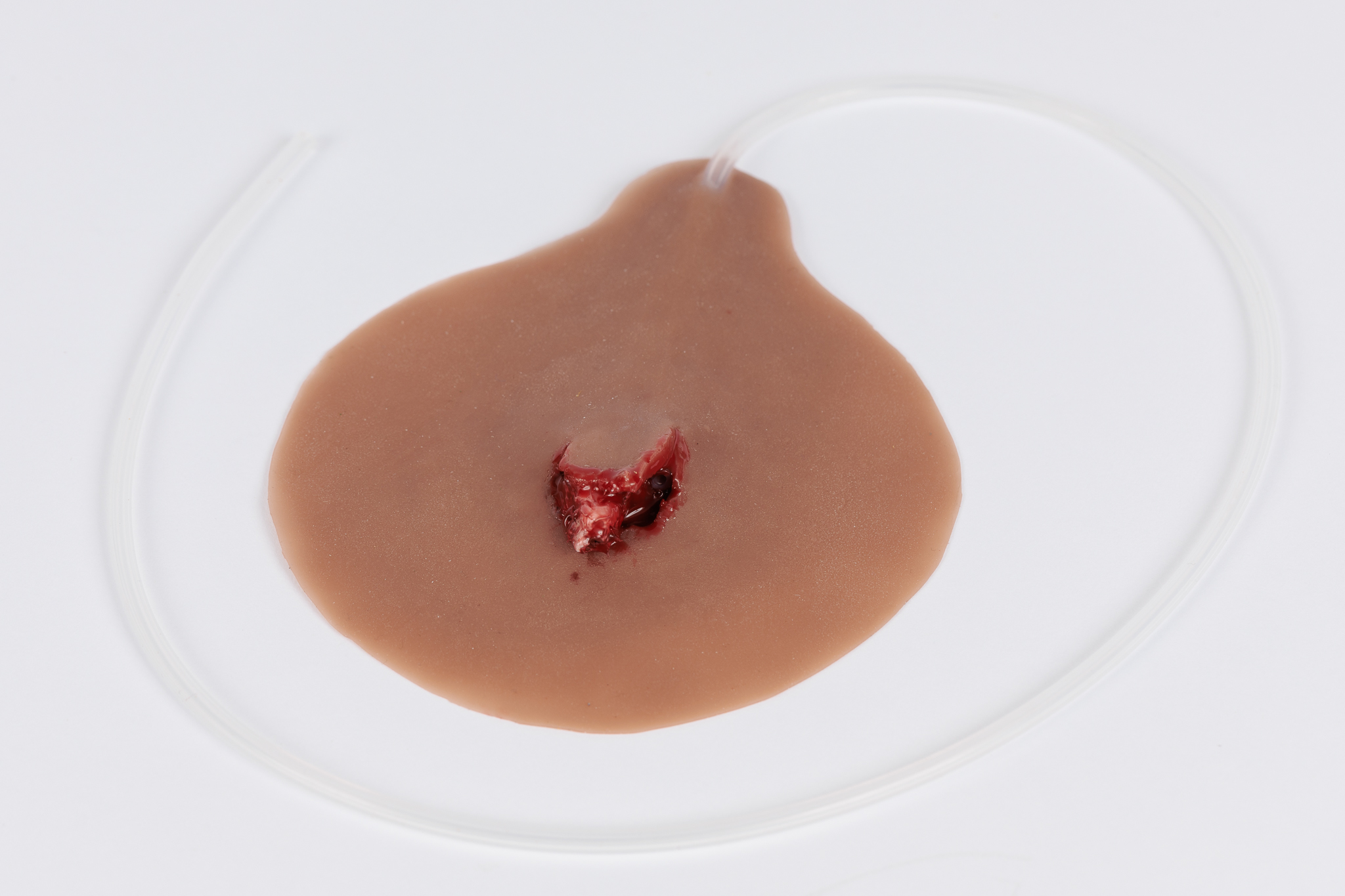 Compound Fracture Rib with Bleeding Capacity - Image 2