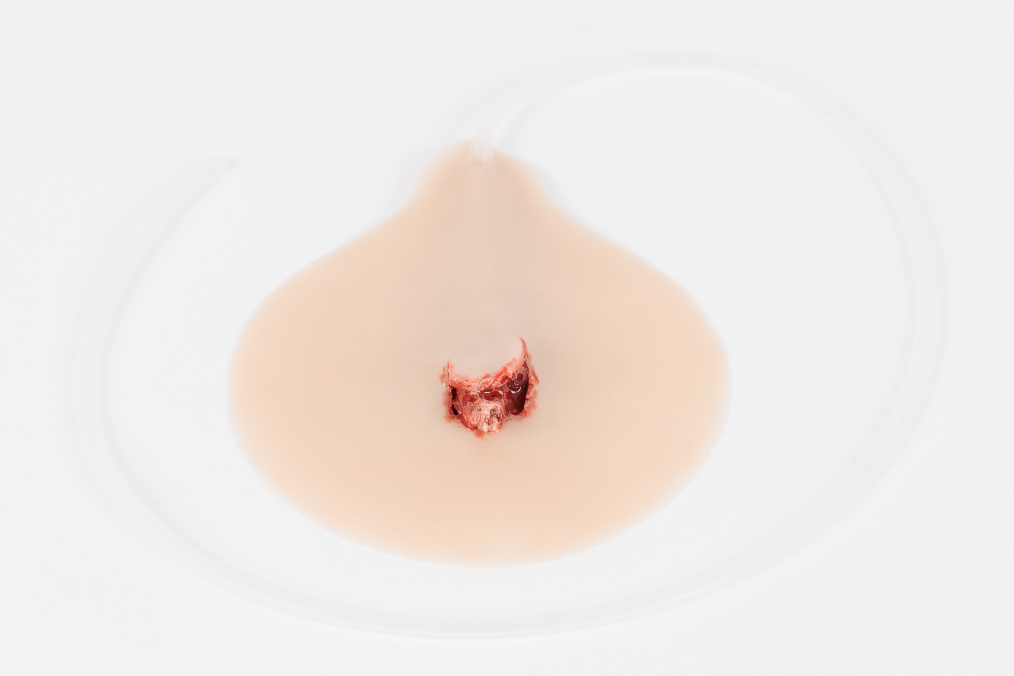 Compound Fracture Rib with Bleeding Capacity - Image 3