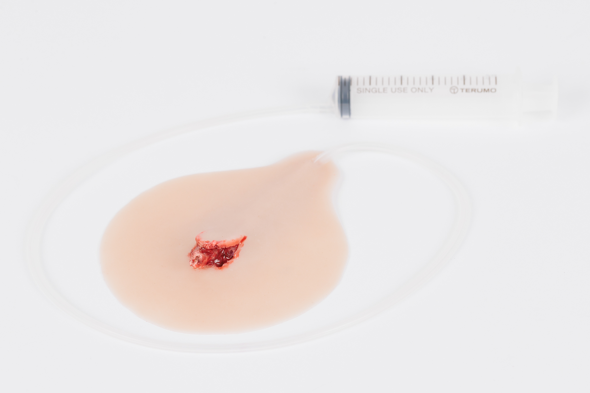 Compound Fracture Rib with Bleeding Capacity - Image 8